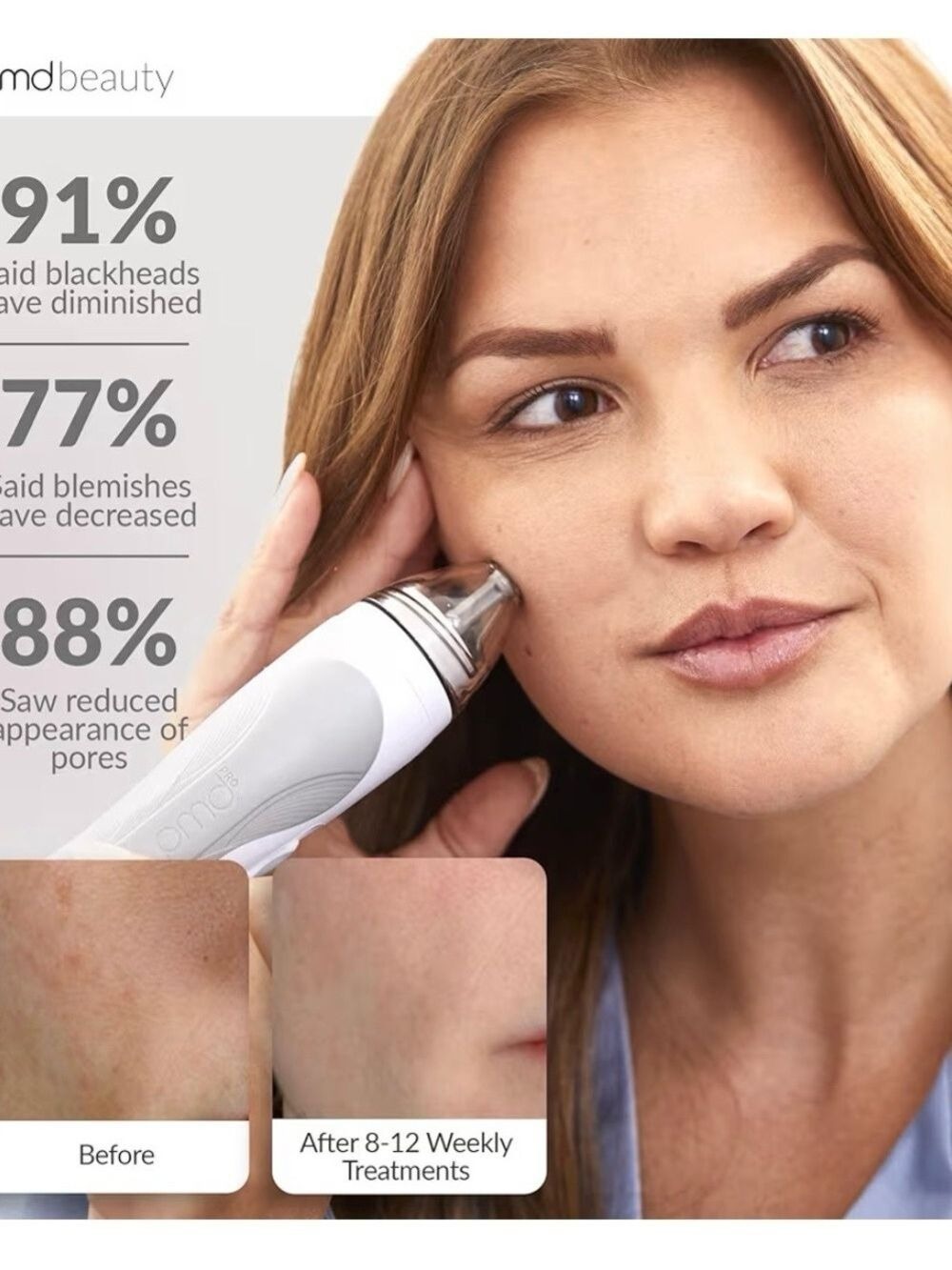 PMD Personal Microderm Classic Clinical-Grade Exfoliation w/ Vacuum Suction NEW - Picture 3 of 6